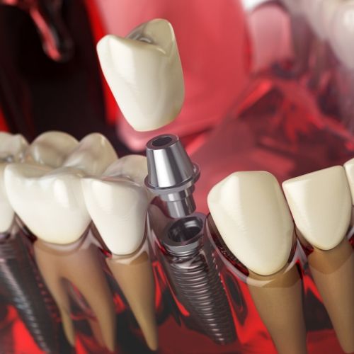 motor de implantes dentales